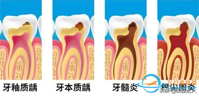 疼到无法入睡的牙髓炎，我们该拿它怎么办？-1.jpg