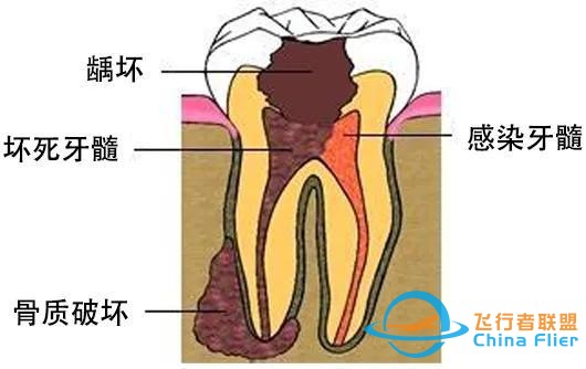 教你5个症状判断是否得了牙髓炎！-1.jpg