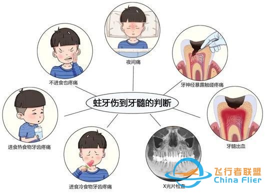 教你5个症状判断是否得了牙髓炎！-2.jpg