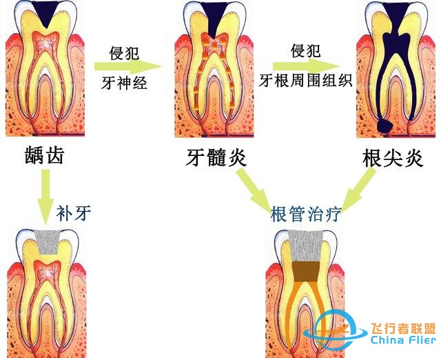 教你5个症状判断是否得了牙髓炎！-3.jpg